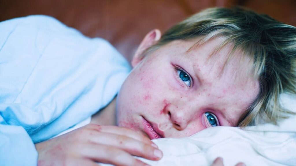 FDA, US, Donald Trump, Covid-19, Measles